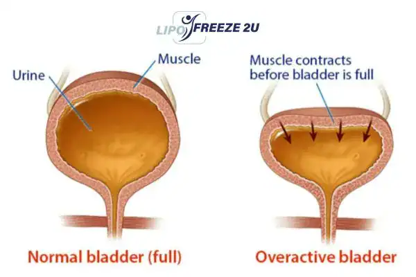 diagram of overactive bladder treatment Dagenham