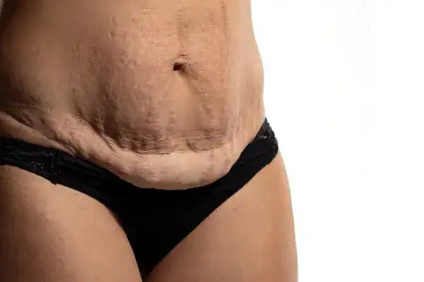 loose skin after weight loss injections Dagenham
