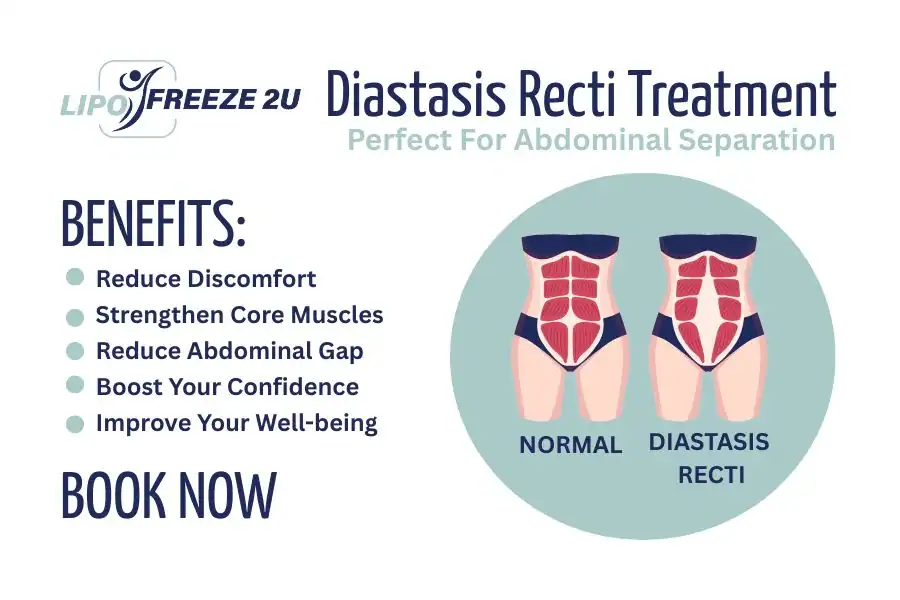 How Long Will It Take to See Improvements in Diastasis Recti Dagenham