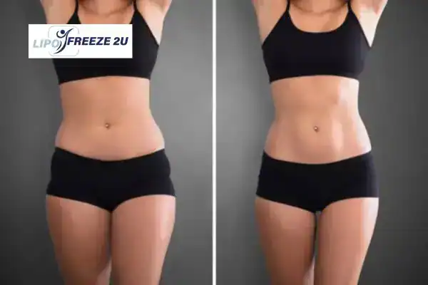 How Can LIPO FREEZE 2U Support Your Post-Pregnancy Body Recovery Dagenham?