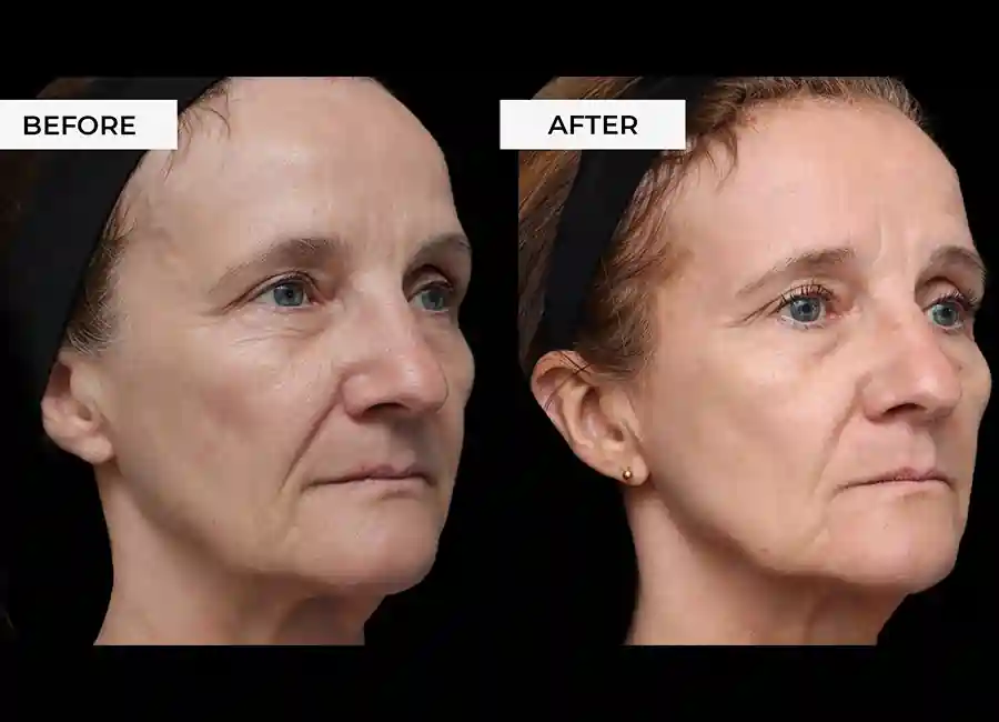 How Many RF Microneedling Sessions Will You Need to See a Difference Dagenham?