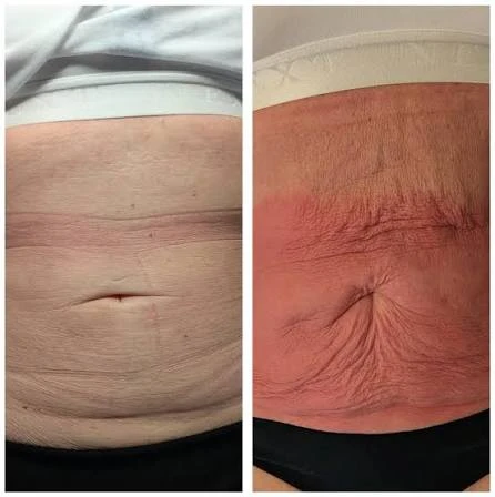 How Does RF Microneedling Improve Crepey, Thin and Uneven Skin Texture Dagenham?