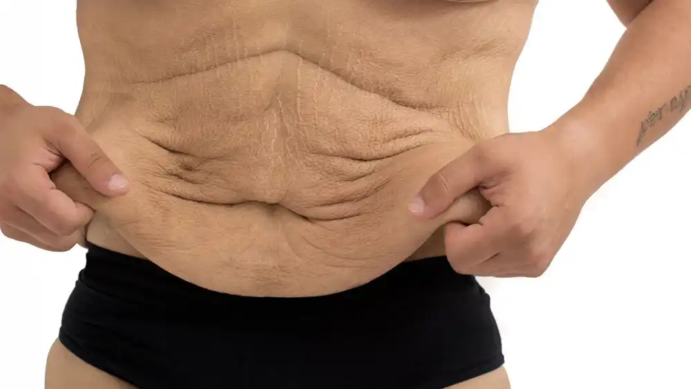 Why Does Weight Loss Medication Leave Some People With Loose or Sagging Skin Dagenham?